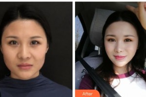 上饒尚美醫(yī)療美容門診部呂丹丹整形價格表附埋線提升案例展示