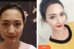 上饒韓美整形美容醫(yī)院黃陽整形價格表附超聲提拉案例展示