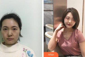 上饒肖發(fā)才醫(yī)療美容診所肖發(fā)才整形價格表附熱瑪吉案例展示