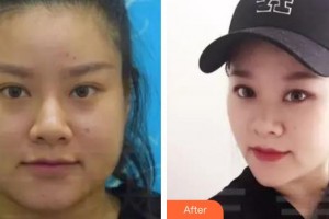 上饒協(xié)和醫(yī)院整形美容科孫家政整形價格表附射頻緊膚案例展示