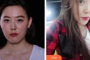 上饒榮美醫(yī)療美容門診部陶小風整形價格表附埋線提升案例展示