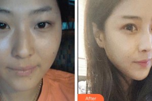 上饒雙博星范醫(yī)療美容門診部毛禹整形價格表附埋線提升案例展示