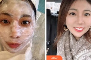 上饒愛爾眼科醫(yī)院徐國芬整形價格表附埋線提升案例展示