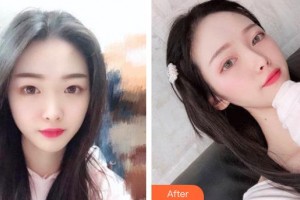 平頂山惟美整形醫(yī)院于偉超整形價(jià)格表附鼻部綜合案例展示