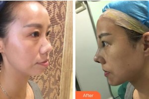 平頂山友誼整形醫(yī)院崔麗整形價(jià)格表附鼻部綜合案例展示