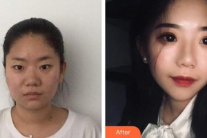 平頂山滕曉醫(yī)療整形醫(yī)院魏毓龍整形價(jià)格表附鼻部綜合案例展示