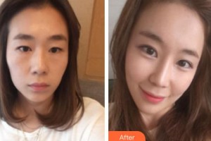 烏魯木齊子桐醫(yī)療美容診所李詠梅整形價(jià)格表附假體隆鼻案例展示