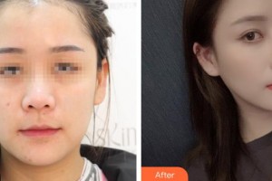 烏魯木齊美容學(xué)會(huì)整形美容門診部許黎整形價(jià)格表附鼻部綜合案例展示