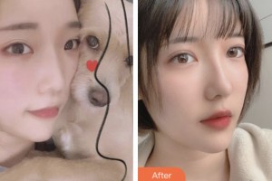 昆山第一人民醫(yī)院燒傷整形科于冶整形價格表附眼部綜合案例展示