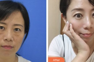 昆山百達(dá)麗醫(yī)療美容門診部沈軍整形價格表附激光去眼袋案例展示