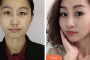 昆山百達(dá)麗醫(yī)療美容門診部薛麗華整形價格表附去痘印痘坑案例展示