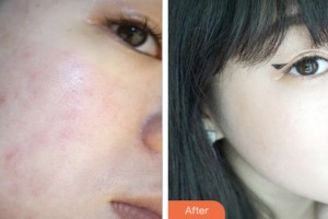 昆山百達(dá)麗醫(yī)療美容門診部馬志丹整形價格表附去痘印痘坑案例展示