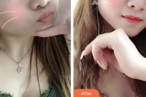 昆山第一人民醫(yī)院燒傷整形科肖貴喜整形價格表附紅藍(lán)光祛痘案例展示