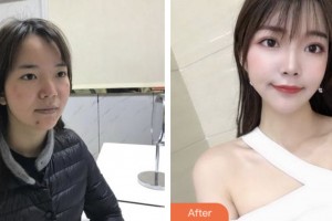 昆山鉑特麗醫(yī)療美容門診部李云鳳整形價格表附紅藍(lán)光祛痘案例展示