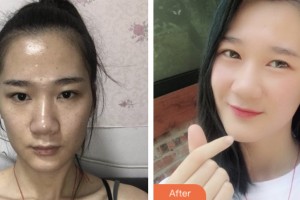 昆山鉑特麗醫(yī)療美容門診部閔熙埈整形價格表附微針?biāo)獍咐故?>
</a>
<h3 class=