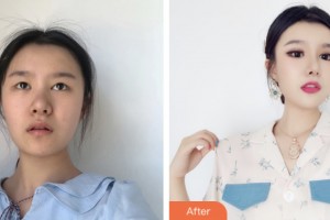 昆山魅萊醫(yī)療美容門診部汪唐華整形價(jià)格表附激光去眼袋案例展示