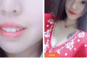 昆山萌牙客口腔門診部張飛飛整形價(jià)格表附牙齒隱形矯正案例展示