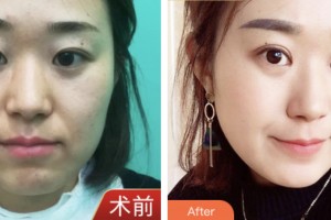 昆山愛爾眼科醫(yī)院肖耀廷整形價(jià)格表附眼部綜合案例展示