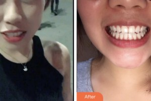 昆山同濟(jì)口腔醫(yī)院田連松整形價(jià)格表附超聲波潔牙案例展示