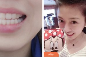 昆山禾豐口腔醫(yī)院朱庭儀整形價(jià)格表附隱形托槽矯正案例展示