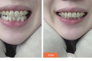 昆山益達(dá)口腔門診部浦海亞整形價(jià)格表附美白貼片案例展示