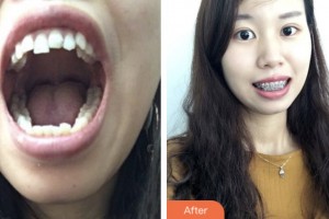 昆山益達(dá)口腔門診部徐恒整形價(jià)格表附金屬托槽矯正案例展示