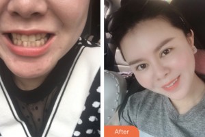 昆山益達(dá)口腔門診部黃向東整形價(jià)格表附牙齒隱形矯正案例展示