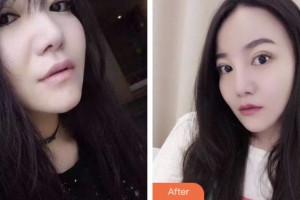 昆山益達(dá)口腔門診部朱肖蒙整形價(jià)格表附牙齒隱形矯正案例展示