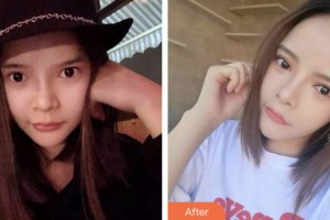 昆山拜博口腔門診部肖求義整形價(jià)格表附牙齒隱形矯正案例展示