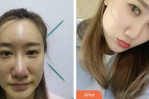 齊齊哈爾醫(yī)學(xué)院附屬第三醫(yī)院醫(yī)療美容科魏林平整形價(jià)格表附眼部綜合案例展示