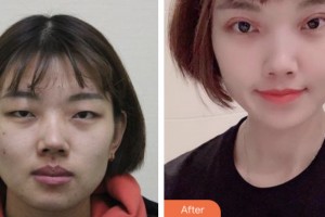 齊齊哈爾醫(yī)學(xué)院附屬第三醫(yī)院醫(yī)療美容科李云峰整形價(jià)格表附切開雙眼皮案例展示