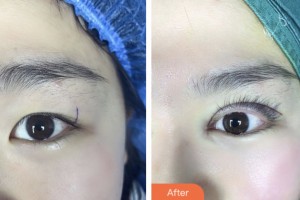 齊齊哈爾愛爾眼科醫(yī)院張焱整形價(jià)格表附眼部綜合案例展示