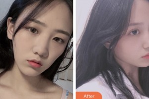 齊齊哈爾千百度整形美容醫(yī)院李鳳浩整形價(jià)格表附切開雙眼皮案例展示