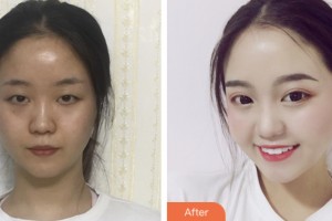 齊齊哈爾千百度整形美容醫(yī)院周冉整形價(jià)格表附眼部修復(fù)案例展示