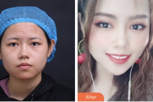 鹽城市第一人民醫(yī)院燒傷整形科刁永力整形價(jià)格表附眼部綜合案例展示