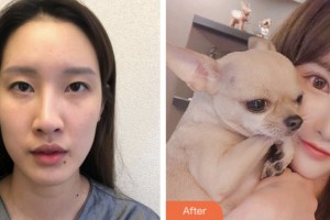 鹽城市第一人民醫(yī)院燒傷整形科葛乃航整形價(jià)格表附眼部綜合案例展示