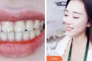 鹽城艾美莉整形美容醫(yī)院江月新住院醫(yī)師整形價(jià)格表附超聲波潔牙案例展示