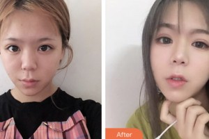 鹽城美得麗德整形美容門(mén)診部鄭在旭整形價(jià)格表附熱拉提案例展示