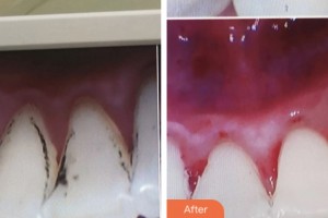 鹽城口腔醫(yī)院石開(kāi)中整形價(jià)格表附超聲波潔牙案例展示