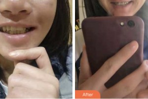 鹽城倍美永康口腔門(mén)診部李晶整形價(jià)格表附金屬托槽矯正案例展示