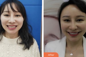 鹽城倍美永康口腔門(mén)診部浦寅飛整形價(jià)格表附牙貼面案例展示