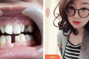 鹽城倍美永康口腔門(mén)診部唐士芹整形價(jià)格表附牙齒隱形矯正案例展示