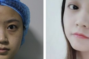 鹽城朝聚眼科醫(yī)院李春梅整形價(jià)格表附眼部綜合案例展示