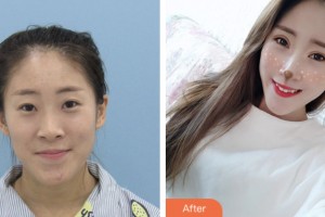 鹽城朝聚眼科醫(yī)院駱亞?wèn)|整形價(jià)格表附眼部綜合案例展示