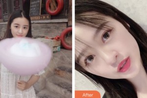 宿遷市洋河人民醫(yī)院眼科石磊整形價格表附切開雙眼皮案例展示