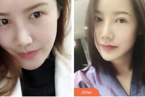 淮安愛爾眼科醫(yī)院肖耀廷整形價(jià)格表附切開雙眼皮案例展示