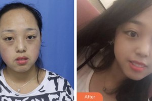 淮安愛爾眼科醫(yī)院張偉整形價(jià)格表附激光去眼袋案例展示