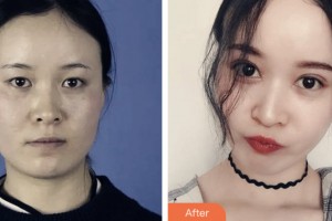 淮安愛爾眼科醫(yī)院李文化整形價(jià)格表附切開雙眼皮案例展示