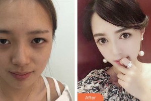 淮安光明眼科醫(yī)院劉慶準(zhǔn)整形價(jià)格表附切開雙眼皮案例展示