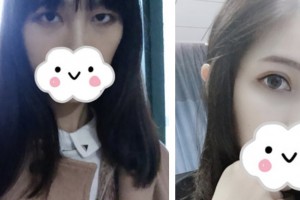 淮安光明眼科醫(yī)院趙少貞整形價(jià)格表附眼部綜合案例展示